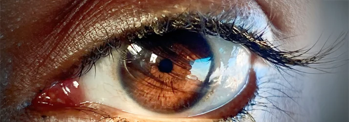 FC – Dry Eye Syndrome Treatment at Greenacres Eye Associates